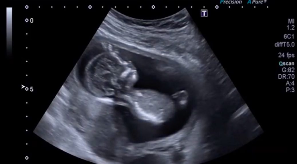 Myles Away from Chronic Insanity